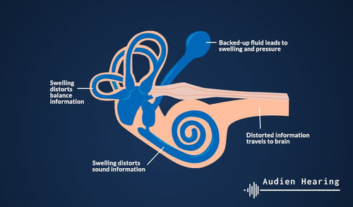 Diagram illustrating different types of tinnitus