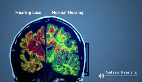 New Research Connects Hearing Loss To Alzheimer's, Dementia & Depression